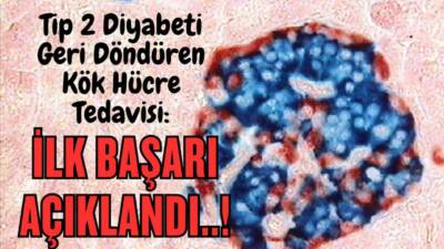 Tip 2 Diyabeti Geri Döndüren Kök Hücre Tedavisi: İlk Başarı Açıklandı..! Bilim insanları, 25 yıllık Tip 2 diyabet vakasında kök hücre