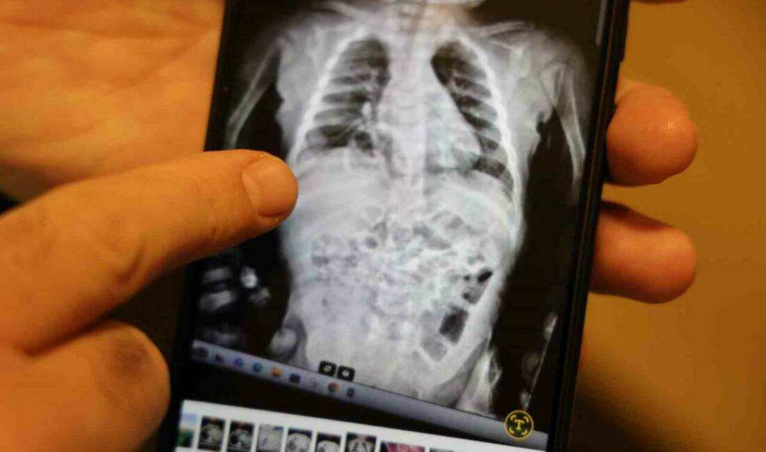 Doğuştan 200 binde bir görülen hastalıkla 2 yıl boyunca yaşayan çocuk sağlığına kavuştu Diyarbakır'da 2 yaşındaki Tevab Aram Zengin, nadir görülen bir diyafram