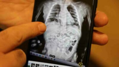 Diyarbakır'da 2 yaşındaki Tevab Aram Zengin, nadir görülen bir diyafram