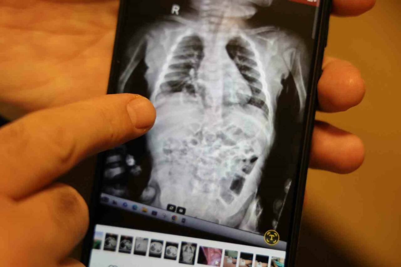 Diyarbakır'da 2 yaşındaki Tevab Aram Zengin, nadir görülen bir diyafram