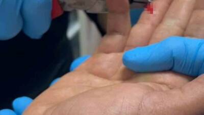 Adıyaman’ın Kahta ilçesinde balık avlamaya giden bir kişinin parmağına saplanan