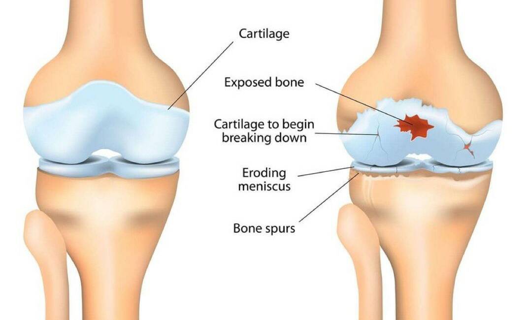 ABD’de Stanford University bünyesinde çalışan bilim insanları, diz ve kalça