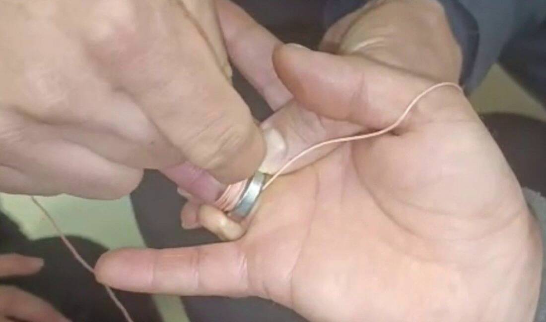 Adıyaman’da parmağına taktığı yüzük nedeniyle zor anlar yaşayan vatandaşın imdadına